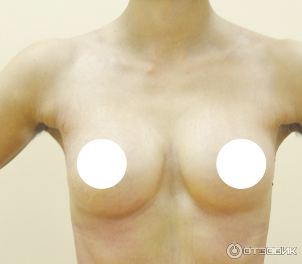 грудь после операции