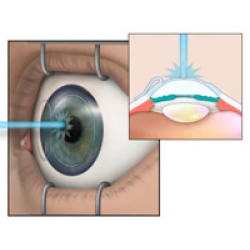 Лазерная коррекция зрения в клинике Прозрение - что нужно знать пациенту?