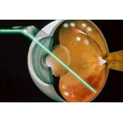 Отзыв о Лазерная коагуляция сетчатки глаза