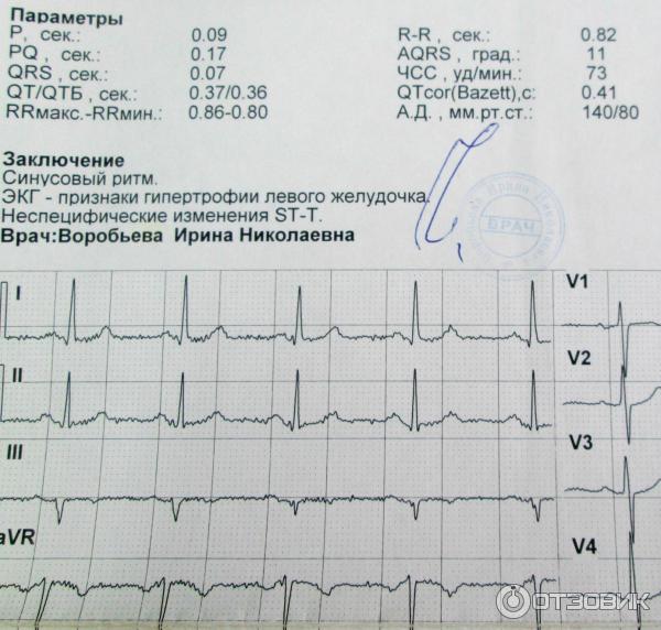 Заключения экг примеры. Показатели электрокардиограммы сердца норма. Показания ЭКГ норма здорового человека. Нормальные показатели интервалов ЭКГ. Кардиограмма сердца норма показатели у здорового человека.