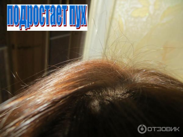 Могут ли от ринфолтила выпадать волосы