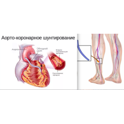 Аортокоронарное шунтирование схема операции