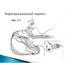 Отзыв о Эндотрахеальный наркоз