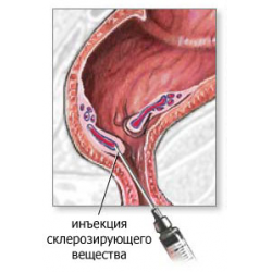 Отзыв о Склерозирование - метод лечения геморроя