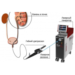 Лазерная Литотрипсия Цена В Москве К31