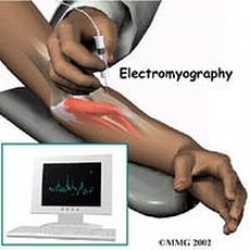 Отзыв о Электронейромиография
