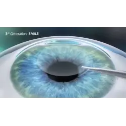 Отзыв о Лазерная коррекция зрения методом Smile