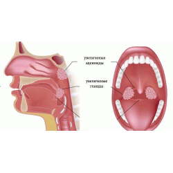 Хирургическое лечение при патологии миндалин в детском возрасте. Что же такое миндалина?